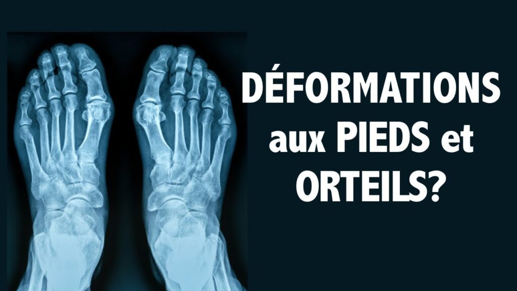 Déformations aux pieds et orteils Programme d exercices niv 1