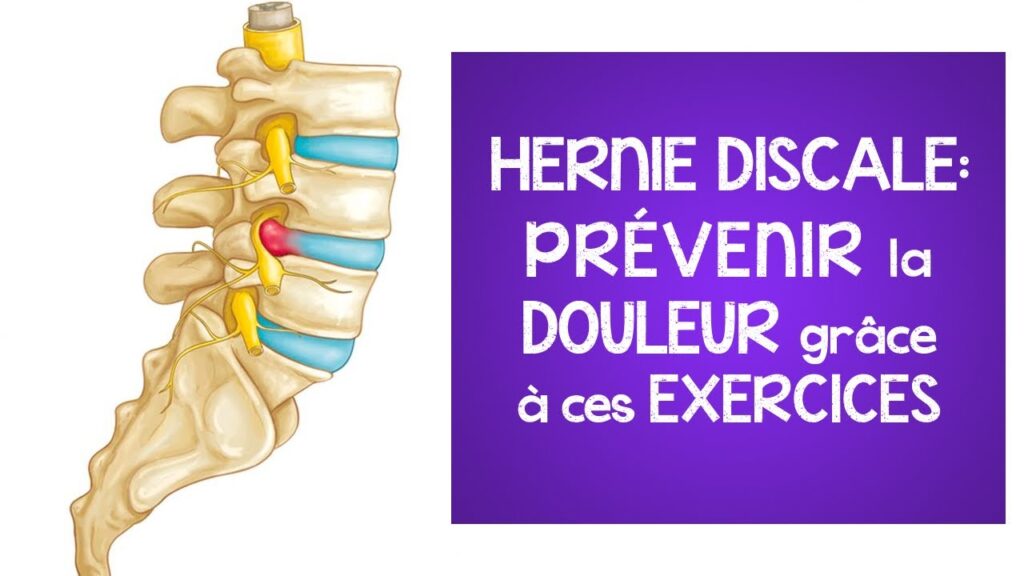 Hernie Discale Pr Venir La Douleur Gr Ce Ces Exercices Lombalgie Et Sciatique Des