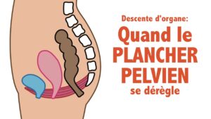 Quand le PLANCHER PELVIEN se DÉRÈGLE: descente d'organe, infos et conseils!