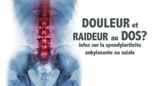 Raideur au dos: info sur la spondylarthrite ankylosante ou axiale