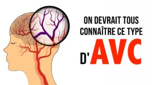 AVC: on devrait tous connaître ce type d'AVC... puisqu'il est le plus fréquent!