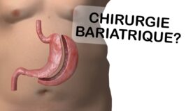 Chirurgie bariatrique: devrais-je y avoir recours?
