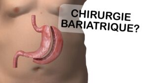 Chirurgie bariatrique: devrais-je y avoir recours?